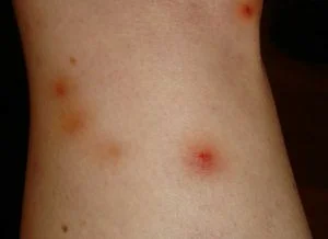 Barata morde pessoas